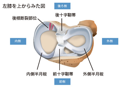 内側半月板の後根断裂