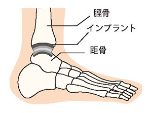 人工足関節置換術