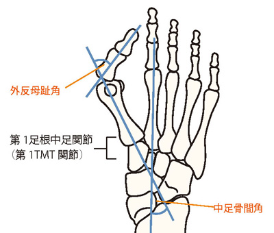 第1足根中足関節