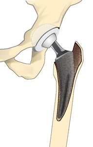 人工股関節置換術