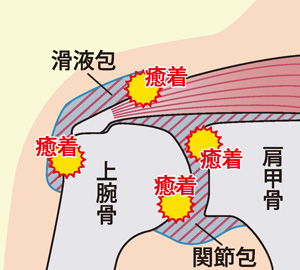 拘縮肩