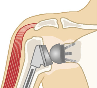 リバース型人工肩関節置換術
