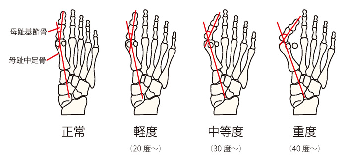 外反母趾の重症度分類