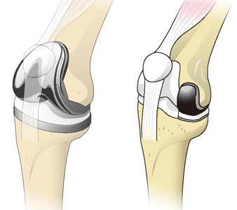 人工膝関節全置換術と部分置換術