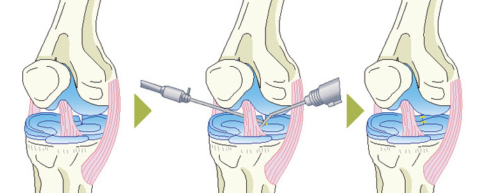 関節鏡手術