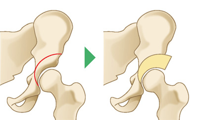 寛骨臼回転骨切り術