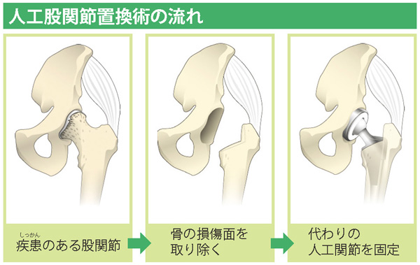 人工股関節置換術の流れ