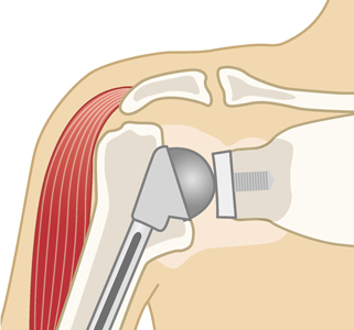 従来型の人工肩関節