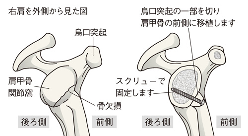 烏口突起移行法の一例（Bristow（ブリストウ）法）