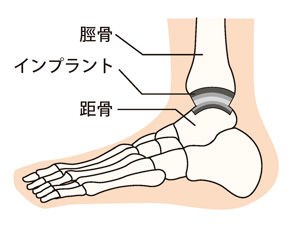 人工足関節置換術