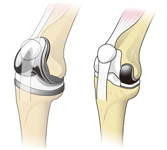 人工膝関節全置換術（左）と部分置換術（右）