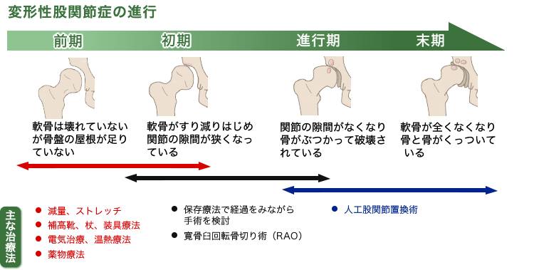 渡邉 弘之 先生 寛骨臼回転骨切り術と人工股関節置換術 第70回 治療を受けても改善しない腰や太ももの痛み まずは一度 股関節の専門医を訪ねましょう 人工関節ドットコム