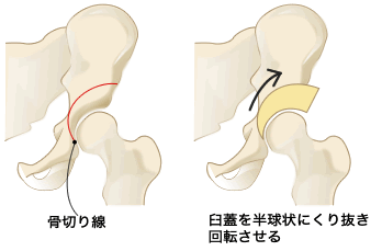 渡邉 弘之 先生 寛骨臼回転骨切り術と人工股関節置換術 第70回 治療を受けても改善しない腰や太ももの痛み まずは一度 股関節の専門医を訪ねましょう 人工関節ドットコム