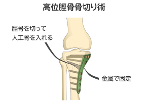 手術療法 変形性膝関節症 Oa 治療法 膝関節の痛み 人工関節ドットコム