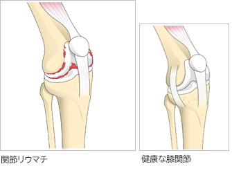 関節リウマチ Ra 膝関節の痛み 人工関節ドットコム