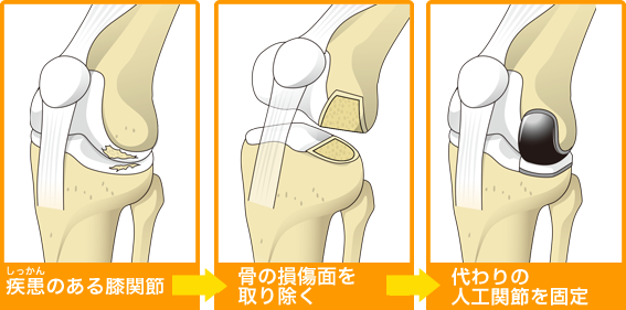 人工膝関節置換術とは 人工膝関節について 人工関節ドットコム 人工膝関節置換術とは 人工膝関節について 人工関節ドットコム