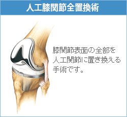 膝の片側だけを人工関節に 人工関節コラム 人工関節ドットコム