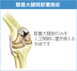 膝のお皿の部分だけを人工関節に 人工関節コラム 人工関節ドットコム