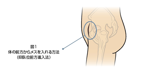 体の前方からメスを入れる方法